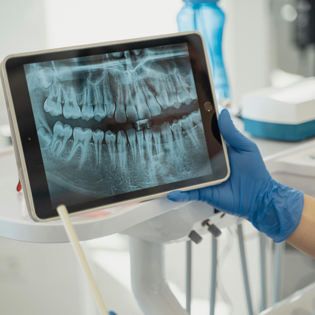 2 Green Dental offers advanced dental implants in Bexleyheath, the number one option for our patients to replace missing teeth and restore the natural function of the teeth. Book an appointment today!
