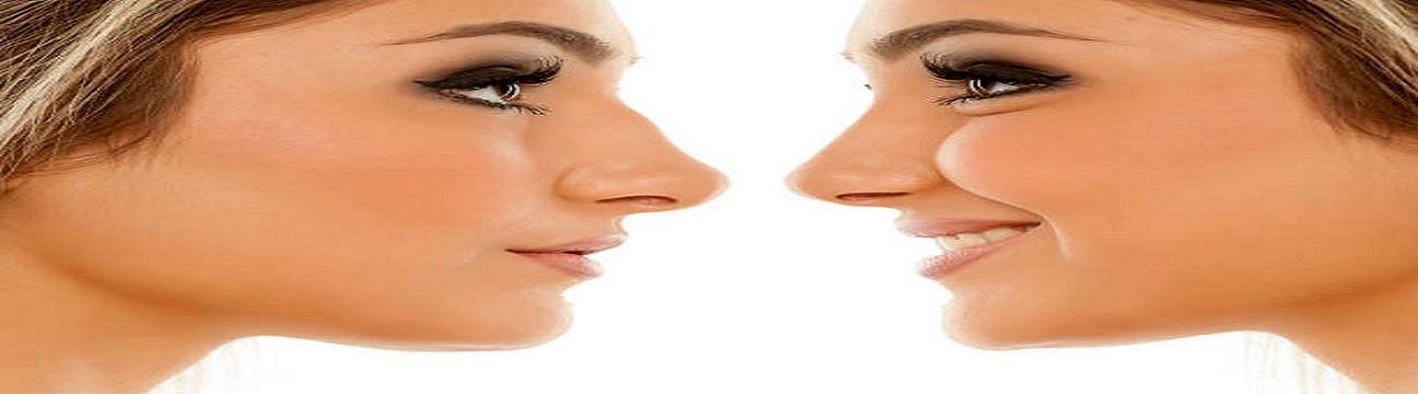 rhinoplasty